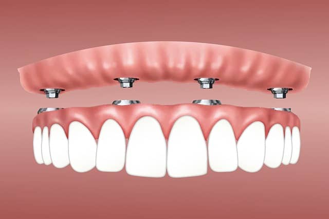 dental implants photo
