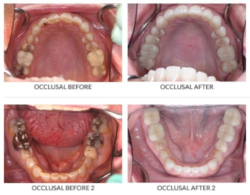 occlusal before after